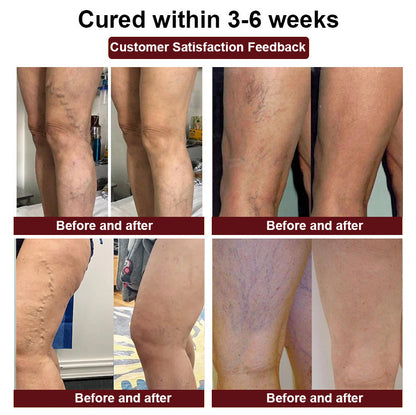 🦵🦵 𝗩𝗮𝗿𝗶𝗰𝗼𝘀𝗲 𝗩𝗲𝗶𝗻 𝗖𝗿𝗲𝗮𝗺 - 𝗣𝗟𝗨𝗦 ( 𝗔𝗩𝗟𝗦 𝗥𝗲𝗰𝗼𝗺𝗺𝗲𝗻𝗱𝘀)
